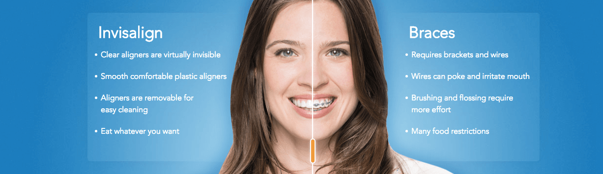 invisalign vs braces