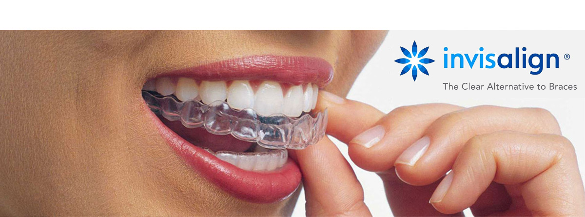 invisalign dentist issaquah